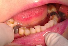 Протезирование жевательных зубов металлокерамическими коронками