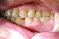 Установка металлокерамических коронок Shofu Halo