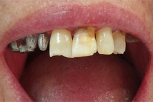 Установка зубных коронок на культевых вкладках