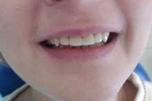 Установка коронок на верхнюю челюсть