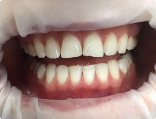 Отбеливание зубов по технологии Zoom 4