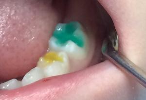 Цветная пломба Твинки Стар при лечении кариеса у ребенка