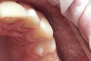 Лечение детского кариеса коренного зуба материалом Эстелайт