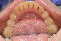 Профессиональная чистка зубного камня