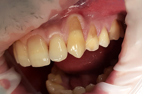 Закрытие рецессии десен 23 и 24 зубов
