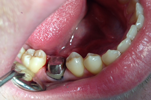 Протезирование моляра циркониевой коронкой