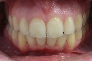 Лечение прикуса комбинированными брекетами Ormco