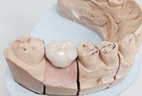 Несъемное протезирование жевательного зуба коронкой на импланте