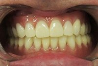 Балочное протезирование на имплантах при частичной адентии