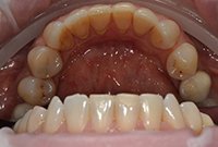 Профессиональная гигиена зубов и десен