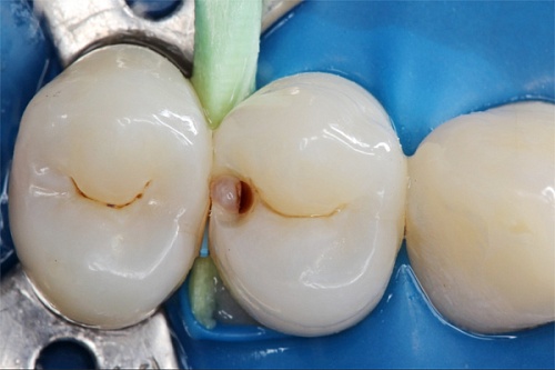 Лечение скрытого кариеса