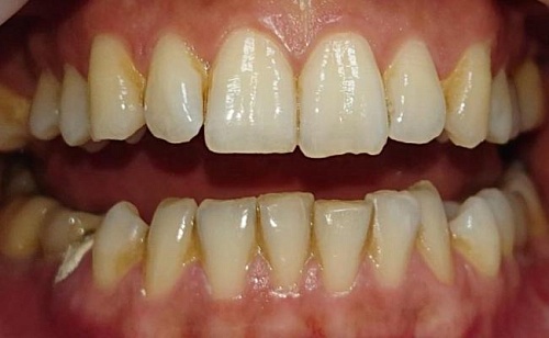 Лечение пародонтита средней тяжести