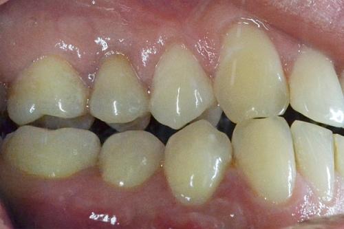Рецессия на нижней челюсти
