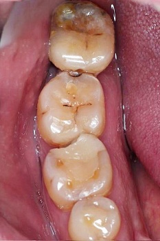 Восстановление жевательных зубов керамическими культевыми вкладками