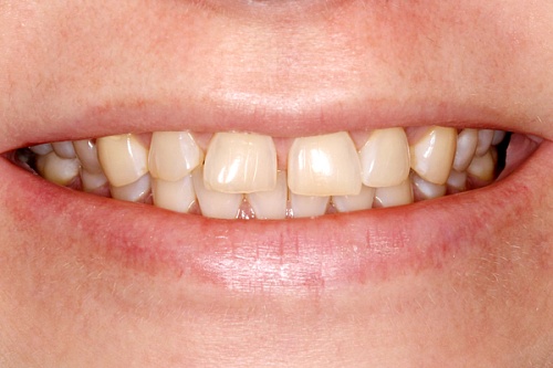 Устранение трем и диастем при помощи виниров E-max