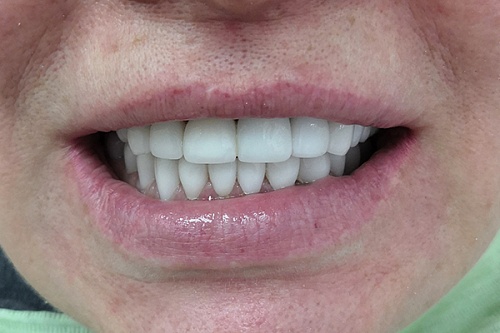 Тотальное протезирование коронками из диоксида циркония