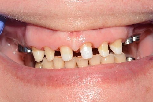 Протезирование коронками из диоксида циркония с использованием мостов