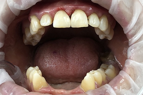 Реставрация зубов верхней челюсти