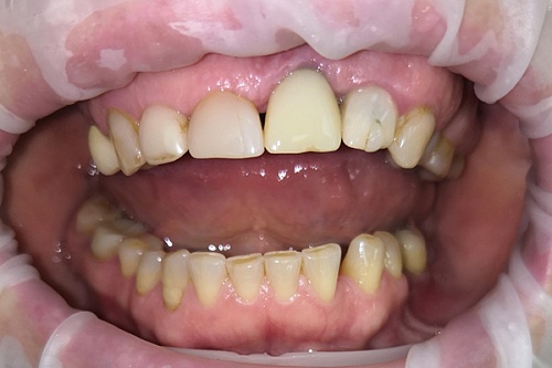 Тотальное протезирование коронками из диоксида циркония