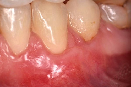 Лечение рецессии десен