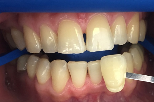 Отбеливание пожелтевших зубов системой Zoom 4