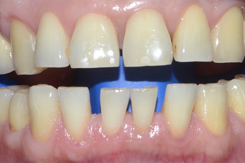 Инновационная система отбеливания ZOOM 3