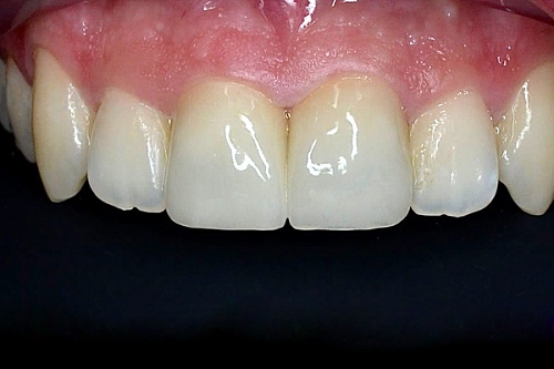 Восстановление центральных резцов керамическими винирами E-Max
