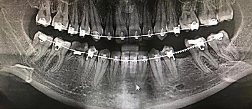 Установка имплантов Impro во время ношения брекетов