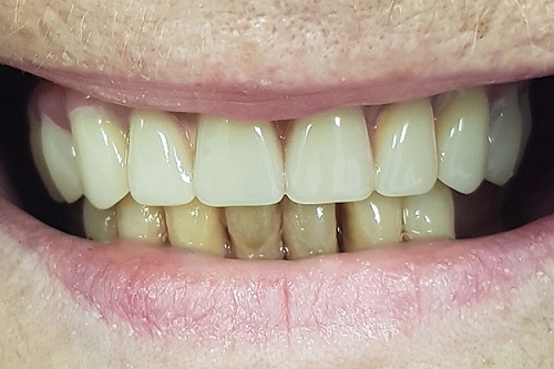 Восстановление верхнего ряда протезированием All-on-4