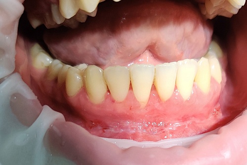 Пластика преддверия и закрытие рецессии десны