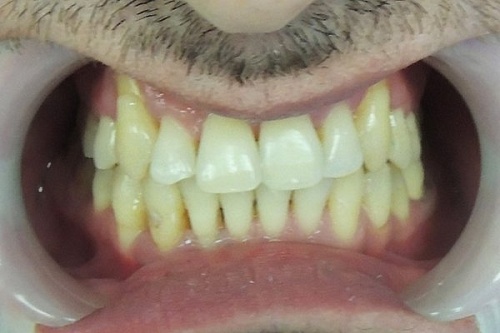 Лечение скученности зубов брекетами In Ovation R