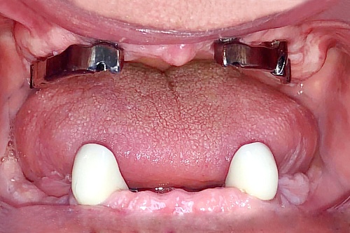 Установка протезов на обе челюсти