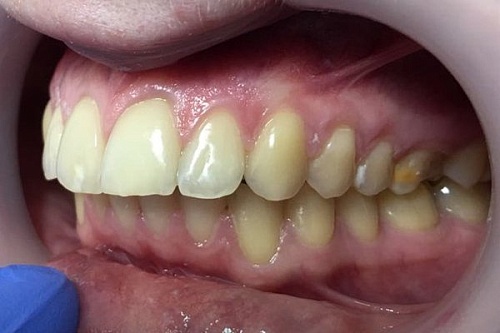 Выравнивание центральных резцов