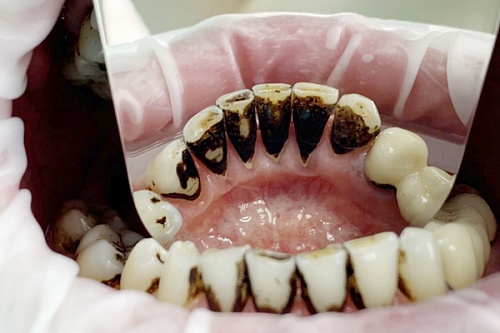 Био-гигиена полости рта с натуральным комплексом солей «Мертвого моря»