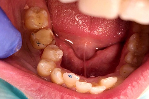 Лечение скрытого кариеса дистальной части зуба