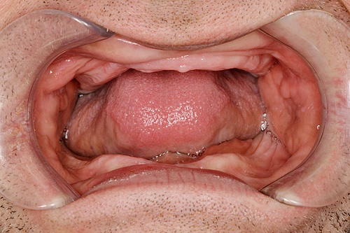 Лечение полной адентии