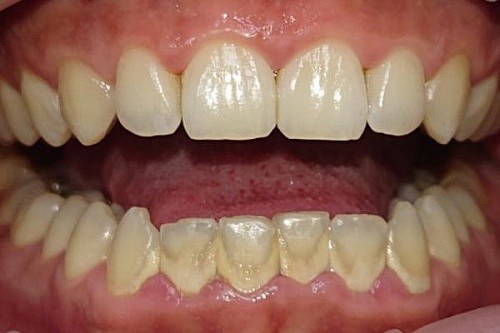 Лечение гингивита