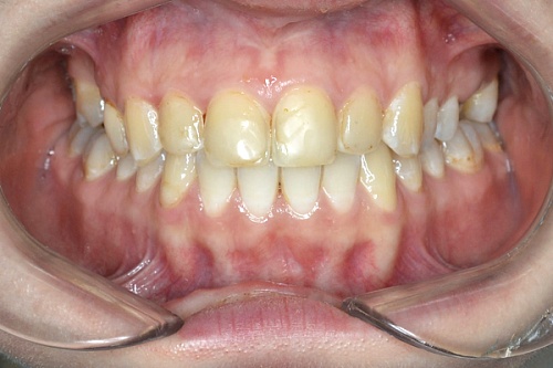 Эстетическая и функциональная реабилитация зубов