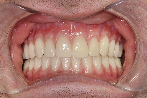 Лечение полной адентии