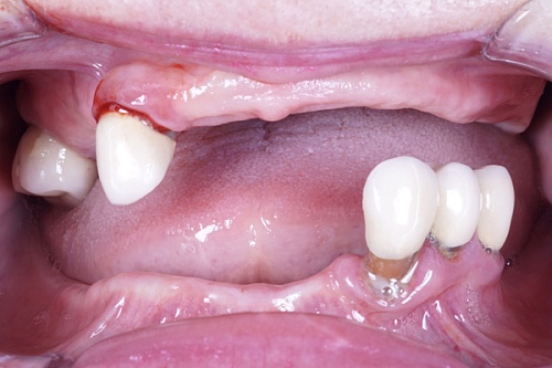 Протезирование All-on-4, верхняя и нижняя челюсти