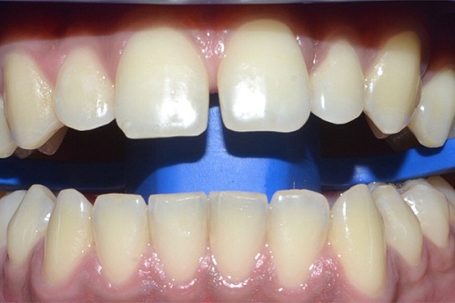 Профессиональное осветление зубной эмали