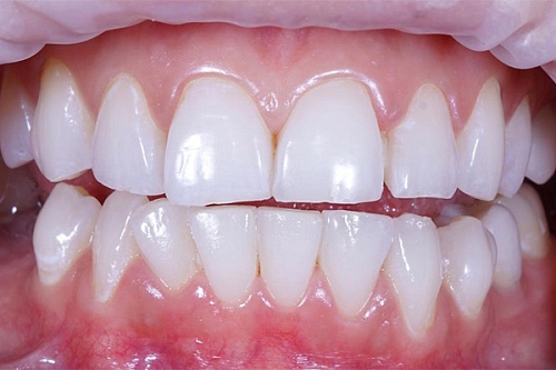 Протезирование винирами E-MAX