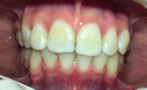 Выравнивание зубов комбинированными брекетами Damon