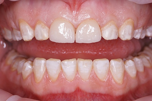 Установка керамических виниров E-max