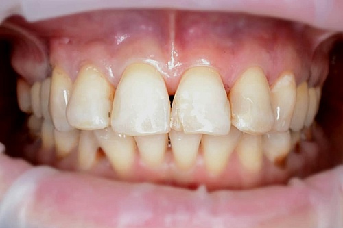 Реставрация зубов