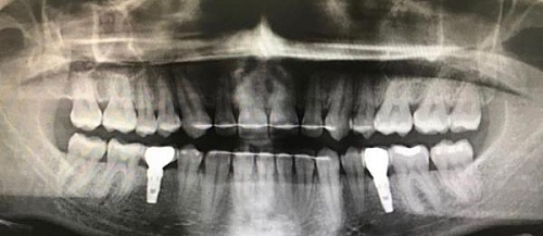 Установка имплантов Impro во время ношения брекетов