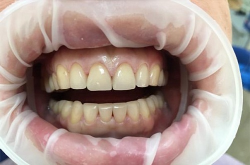 Установка виниров и бескаркасной керамики