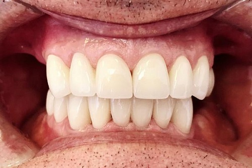 Установка безметалловых керамических коронок