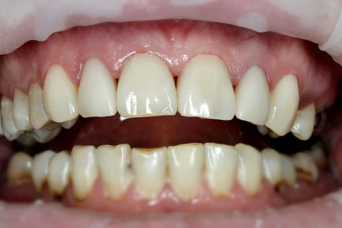 Установка композитных виниров в зоне улыбки