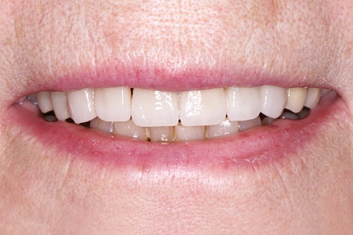 Комплексное лечение передних зубов